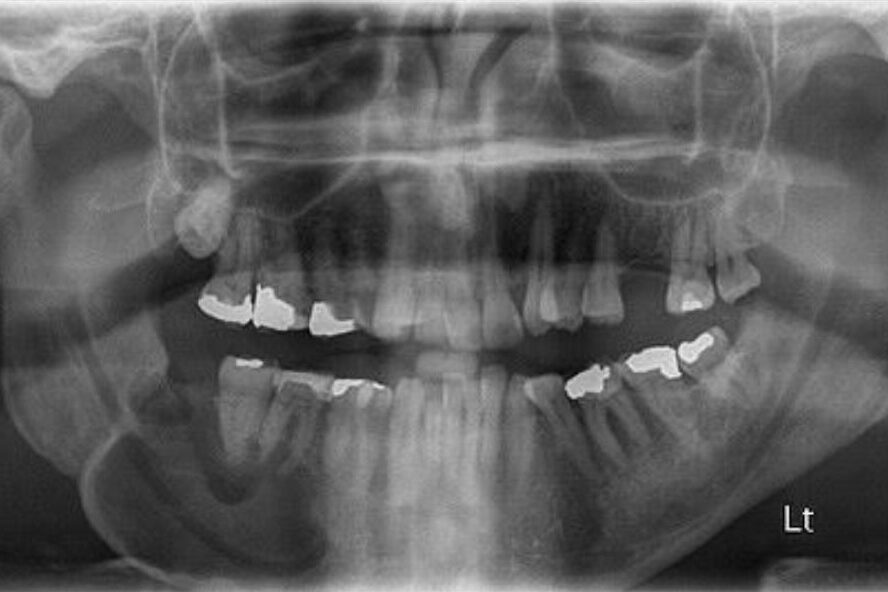 OPG X-ray (Orthopantomography)