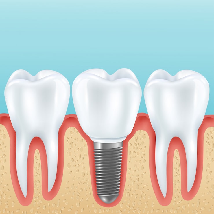 Root_Canal Cost effective and professional root canal treatment at SCR Clinic